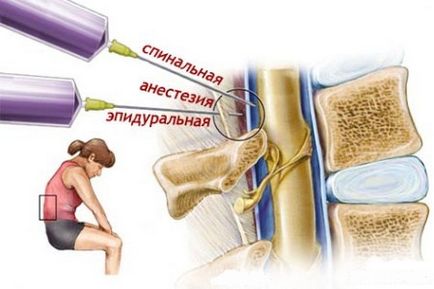 anestezie epidurala in timpul nasterii, este, consecințele