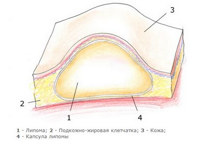 Fibrolipoma ce este