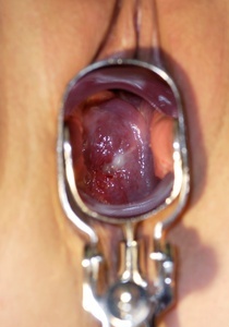 Fotografii de eroziune de col uterin (18 poze)