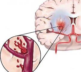 efecte accident vascular cerebral hemoragic, prognostic, reabilitare, simptome