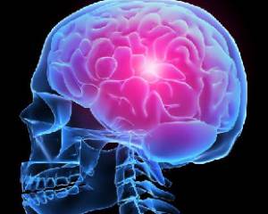 efecte accident vascular cerebral hemoragic, prognostic, reabilitare, simptome