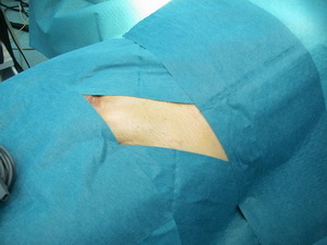 Hernioplasty (herniei) - ceea ce este, chirurgie, preturi, video