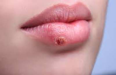 Herpes pe buzele a ceea ce este, cauzează și ce să facă