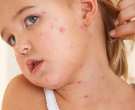 Herpes simptomelor copiilor si tratamentul virusului in organismul copilului