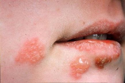 Herpes simptomelor copiilor si tratamentul virusului in organismul copilului