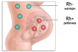 hiperbilirubinemie benign, cauze neonatale, tratament