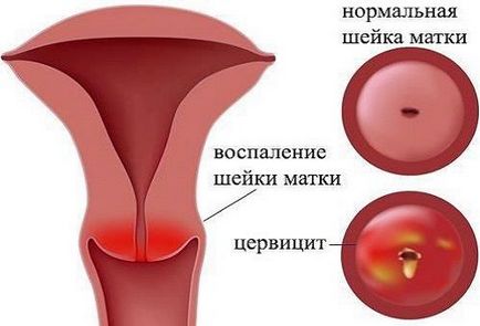 hipertrofia de col uterin