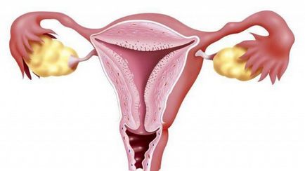 hipertrofia de col uterin