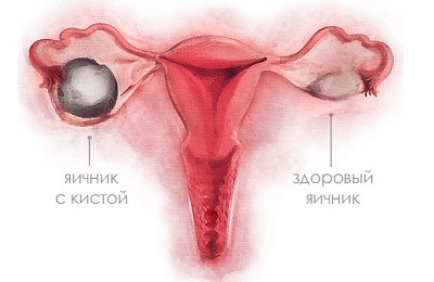 Cauzele hipertrofia cervicale și tratament, cum să scape de remedii populare