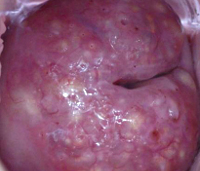hipertrofia de col uterin - cauze, simptome, diagnostic și tratament