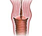 hipertrofia de col uterin - cauze, simptome, diagnostic și tratament