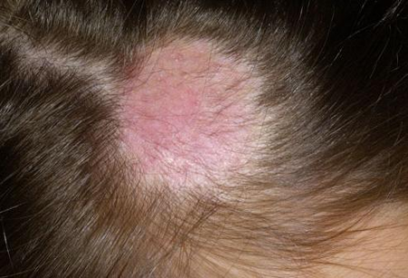 Simptomele micotice boala de piele si tratament 1
