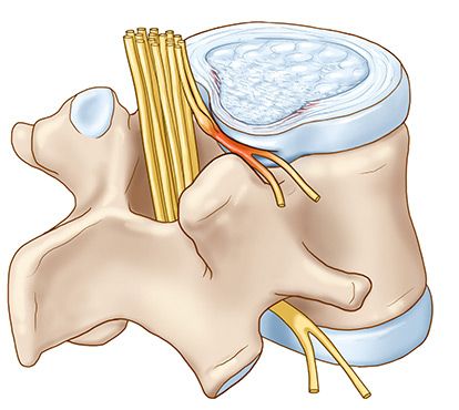 spinării hernie - cauze, simptome, tratament, prevenire