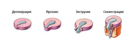 spinării hernie - cauze, simptome, tratament, prevenire