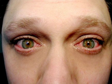simptome de infectare cu ochi