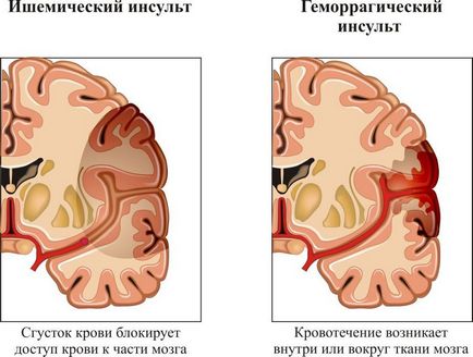 Cauzele accidentului vascular cerebral ischemic, simptome, tratament