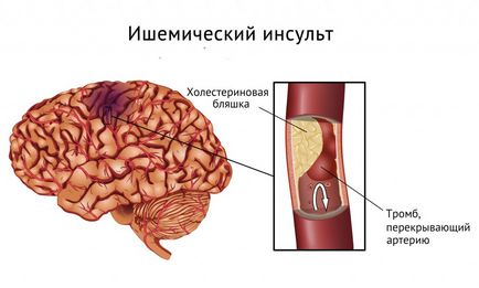 Cauzele accidentului vascular cerebral ischemic, simptome, tratament