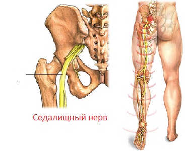 simptome sciatica, cauze, tratament, prevenire