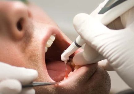 Cum sa scapi si vindecarea cariilor dentare