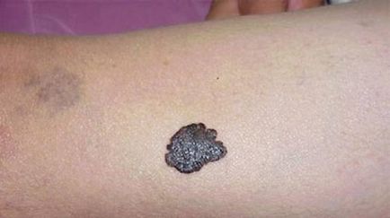Cum de a trata melanomul
