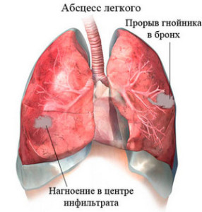 Cum tratamentul Staphylococcus aureus
