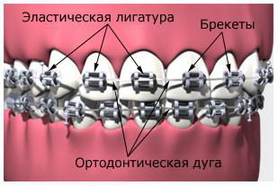 Cum bretele, articole despre ortodonție pentru copii