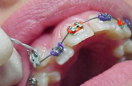 Cum bretele, articole despre ortodonție pentru copii