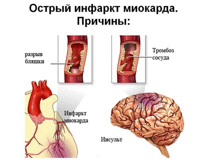 Cum de a recunoaște un infarct miocardic pe ECG - performanta decodare