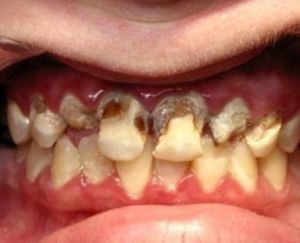 Cum de a salva dintii putred de ce au putregai, consecințele pentru organism, ce să facă