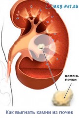 Cum de a expulza pietre la rinichi - experiența mea personală