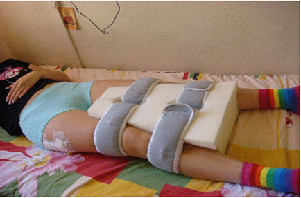 Cum de a recupera de înlocuire a șoldului (înlocuire) Cum de a recupera de la o înlocuire de șold