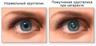 ochi cataractă