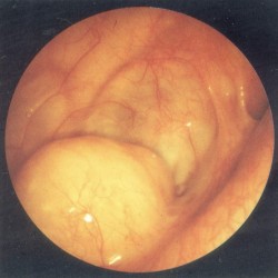 Chist al sinusului maxilar cauze, simptome, diagnostic, toate sinuzita