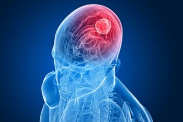Tipuri de chisturi creier, simptome și tratament