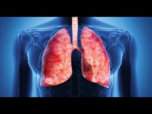 cauze pulmonare chisturi și simptome, diagnostic și tratament