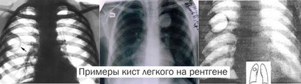 simptome chisturi pulmonare, tratament si remedii populare