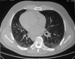Tomografia computerizată a plămânilor și bronhiilor kt, respiratorii