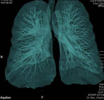 tomografia pulmonare calculator (CT), care arată cât de des