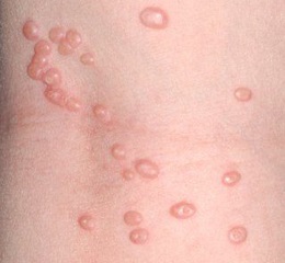 simptome molluscum contagiosum, fotografie, tratament, cauze