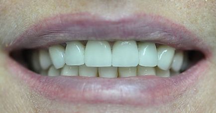 Coroanele pe dinti, pacienții de preț și recenzii față