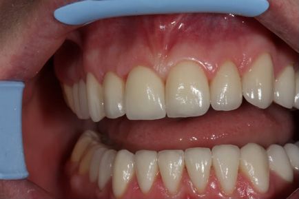 Coroanele pe dinti, pacienții de preț și recenzii față