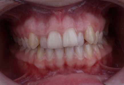 Dinții frumoși - cum să faci și cât de mult costă