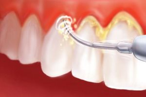 Sangerarea gingiilor care fac, farmacie și remedii populare