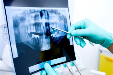 Chiuretajul pungilor parodontale - adică, indicațiile pentru procedura