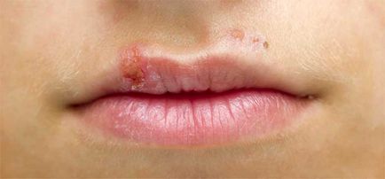 herpesul labial este ceea ce este, simptome, tratament