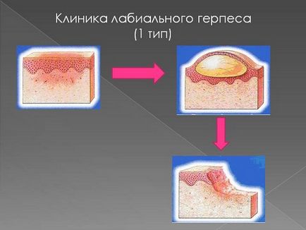 Labială herpes cura, ceea ce este și fotografii