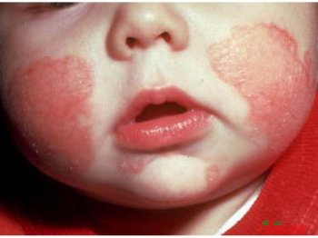 Tratamentul cu dermatita atopica remedii populare (dermatită) Tratamentul cu dermatita atopica remedii populare