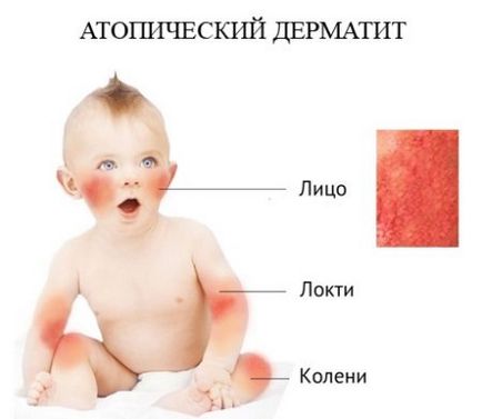 Tratamentul dermatitei atopice la copii remedii populare (26 poze)