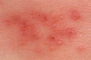 remedii populare Herpes Tratament ambulatoriu