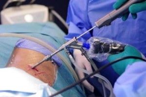 Tratamentul și hernia operație cu laser îndepărtarea coloanei vertebrale cervicale de disc și vaporizarea